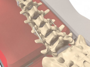 Human Spine and Implant Modèle 3D