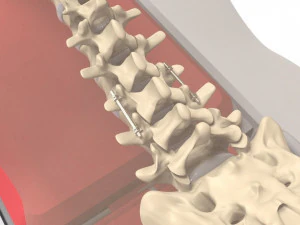 Human Spine and Implant 3D Model