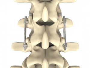 Human Spine and Implant 3D Model