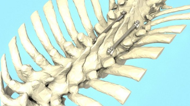 Spine Implant 3D Модель .c4d .max .obj .3ds .fbx .stl .blend 