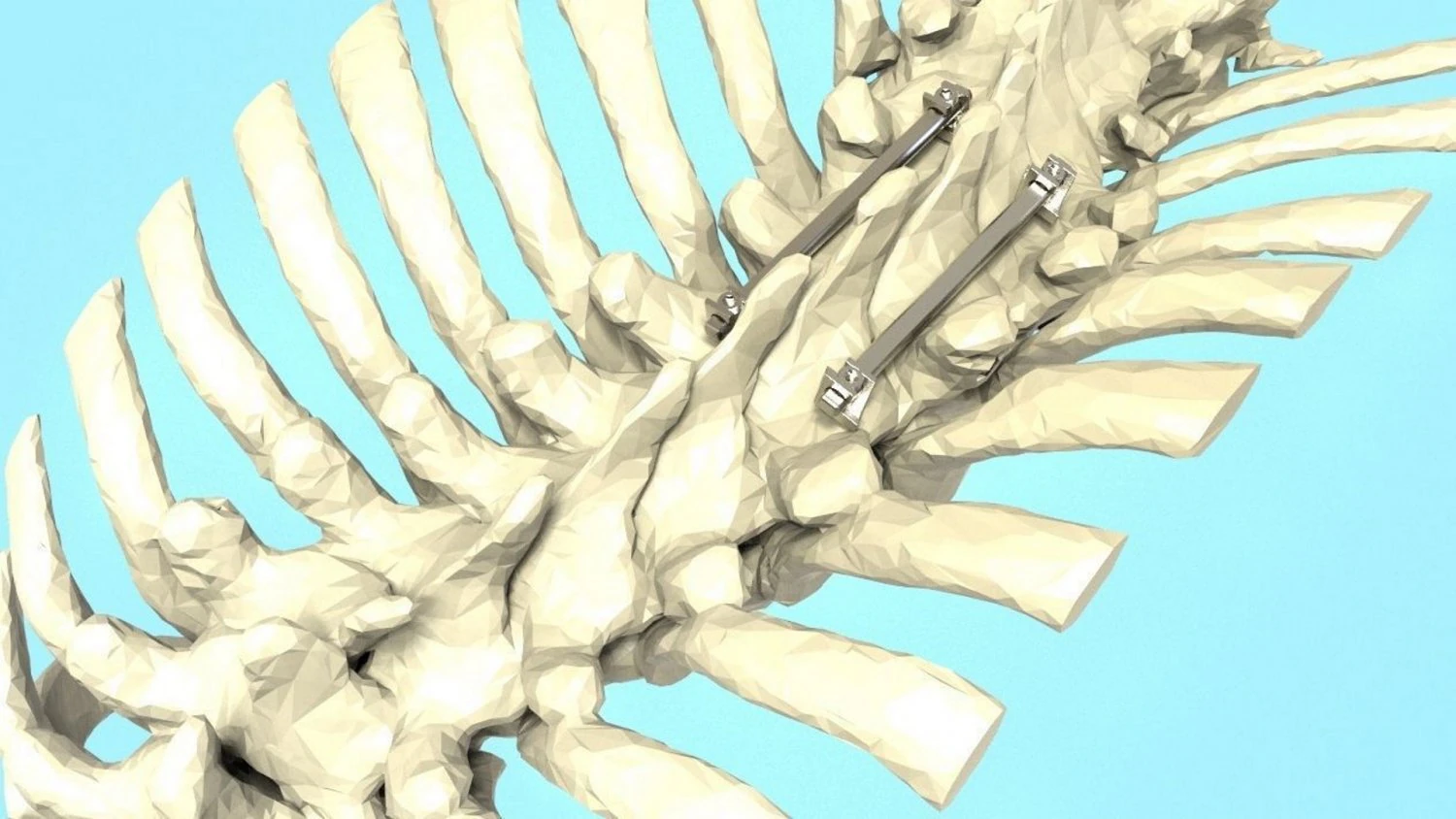 Spine Implant 3D Model .c4d .max .obj .3ds .fbx .stl .blend 