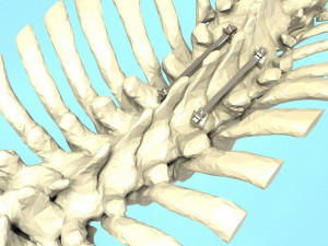 Spine Implant 3D Model