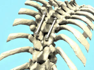 Spine Implant 3D Model