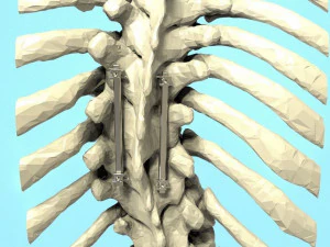 Spine Implant 3D Model