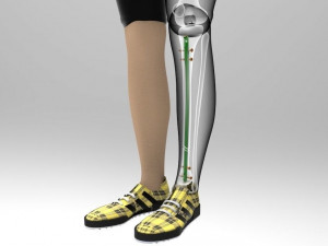 Tibial Intramedullary Nail Modèle 3D
