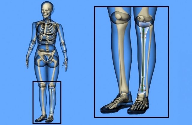 Tibial Intramedullary Nail Modèle 3D .c4d .max .obj .3ds .fbx .stl .blend 