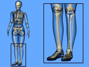 Tibial Intramedullary Nail 3D Model