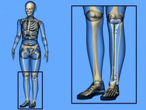 脛骨髄内釘 3Dモデル