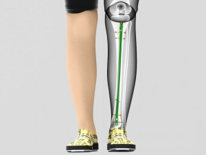 Tibial Intramedullary Nail Modèle 3D