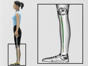 Tibial Intramedullary Nail Modèle 3D