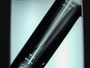 Tibial Intramedullary Nail Modèle 3D