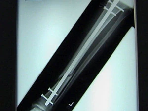 Tibial Intramedullary Nail 3D Model