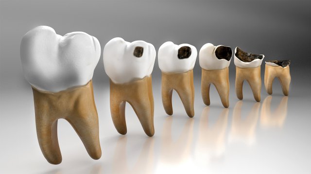 Human Tooth Decay A 3D Dental Caries Progression Model 3D Модель .c4d .max .obj .3ds .fbx .stl .blend 