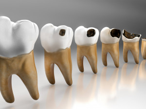 Human Tooth Decay A 3D Dental Caries Progression Model 3D Model