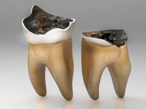 Human Tooth Decay A 3D Dental Caries Progression Model 3D Model