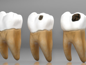 Human Tooth Decay A 3D Dental Caries Progression Model 3D Модель