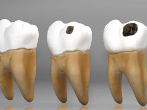 Human Tooth Decay A 3D Dental Caries Progression Model 3D Model