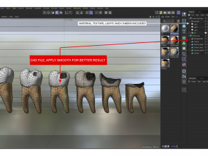 Human Tooth Decay A 3D Dental Caries Progression Model 3D Модель