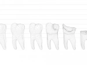 Human Tooth Decay A 3D Dental Caries Progression Model 3D Model