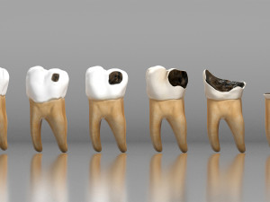 Human Tooth Decay A 3D Dental Caries Progression Model 3D Модель