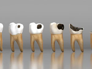 Human Tooth Decay A 3D Dental Caries Progression Model 3D Model