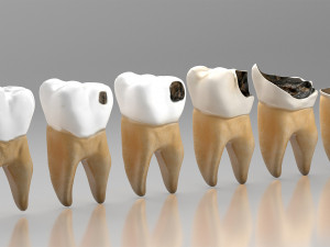 Human Tooth Decay A 3D Dental Caries Progression Model 3D Модель