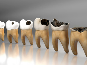 Human Tooth Decay A 3D Dental Caries Progression Model 3D Модель