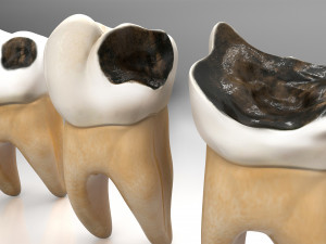 Human Tooth Decay A 3D Dental Caries Progression Model 3D Модель
