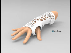 arm splint - 3d print 3D Print Model
