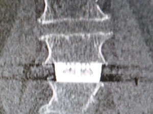 vertebral implants lumbar cage m4 thread real operation 3D Model