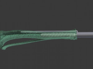 itap implant osteointegration operation Modelo 3D