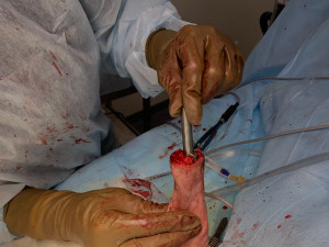 itap implant osteointegration operation Modelo 3D