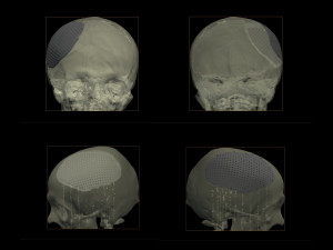 the plate for cranioplasty real example 3D 모델