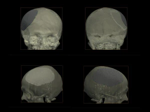 the plate for cranioplasty real example 3D Model