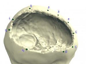 the plate for cranioplasty real example 3D 모델