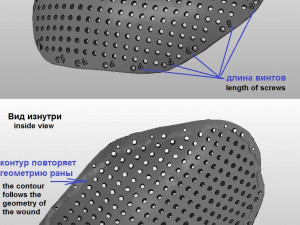 the plate for cranioplasty real example 3D 모델
