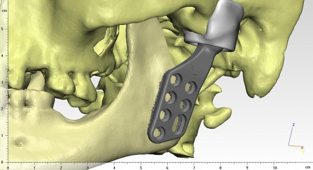 individual tmj prosthesis real operation Model 3D .c4d .max .obj .3ds .fbx .stl .blend 