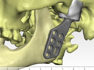 individual tmj prosthesis real operation 3D Model