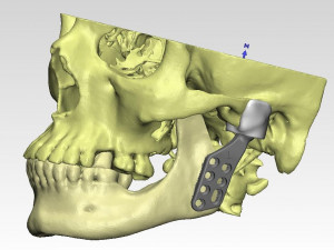 individual tmj prosthesis real operation Model 3D