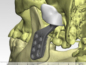 individual tmj prosthesis real operation Model 3D