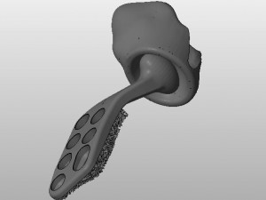 individual tmj prosthesis real operation Model 3D
