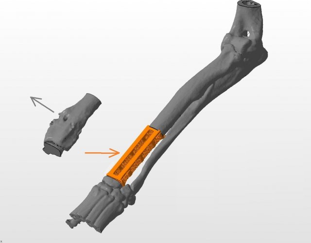 an example of a real organ-preserving operation for osteosarcoma Modelo 3D .c4d .max .obj .3ds .fbx .stl .blend 