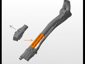 an example of a real organ-preserving operation for osteosarcoma 3D Model