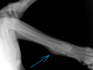 an example of a real organ-preserving operation for osteosarcoma Modelo 3D
