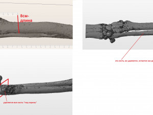 an example of a real organ-preserving operation for osteosarcoma Modelo 3D