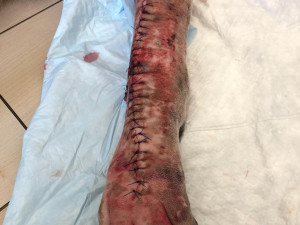 an example of a real organ-preserving operation for osteosarcoma Modelo 3D