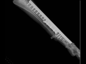 an example of a real organ-preserving operation for osteosarcoma Modelo 3D