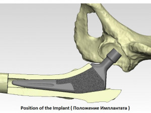 tibia implant real model for training 3D मॉडल