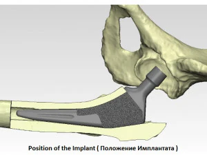 tibia implant real model for training 3D Model