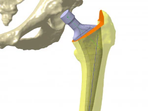 tibia implant real model for training 3D Model